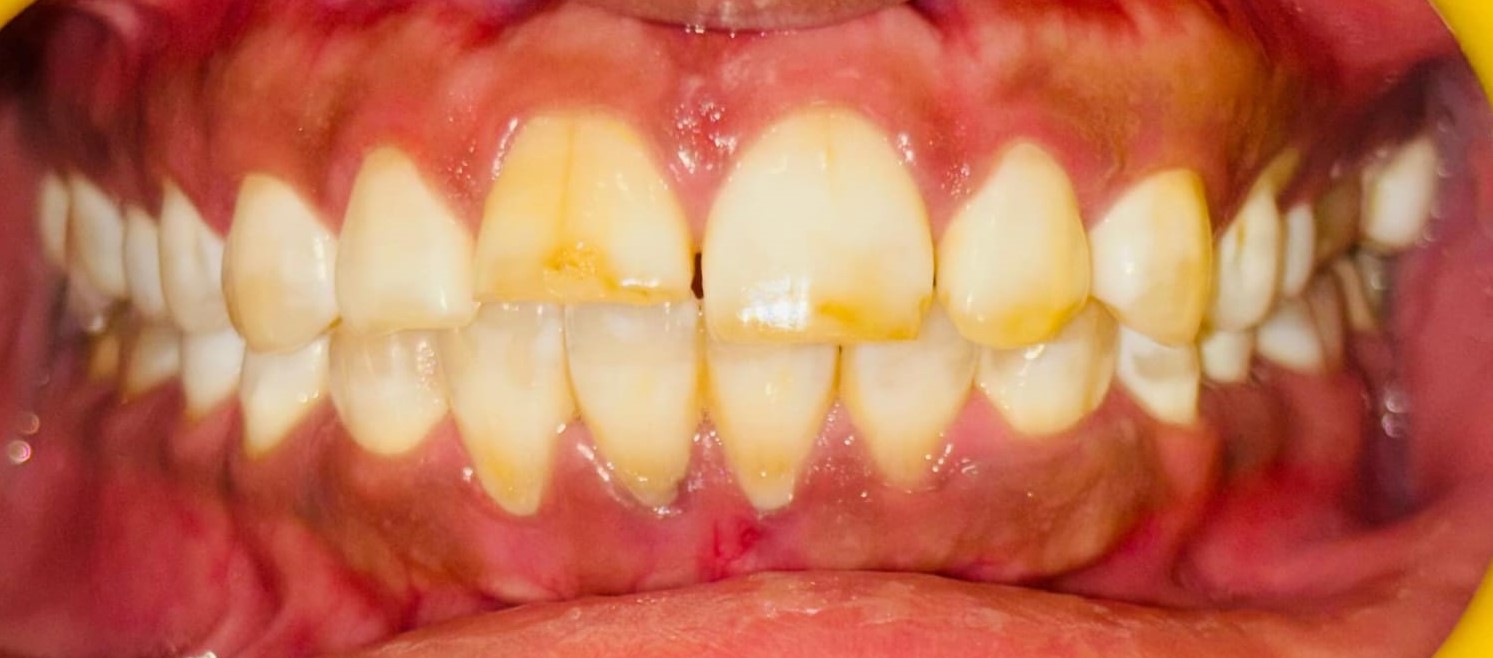 Before crown lengthening